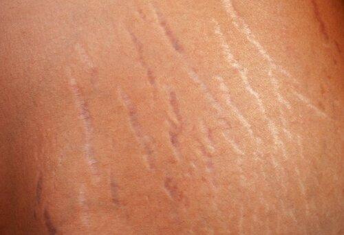 Stretch Mark Care During Pregnancy | Mum Bub Hub