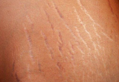 Stretch Mark Care During Pregnancy