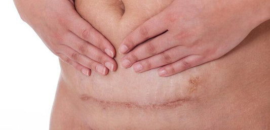 Preparing for a planned c-section | Mum Bub Hub 