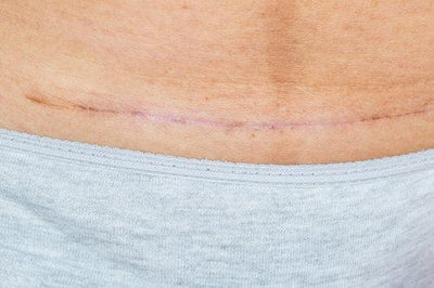Recovering from a C-Section Delivery